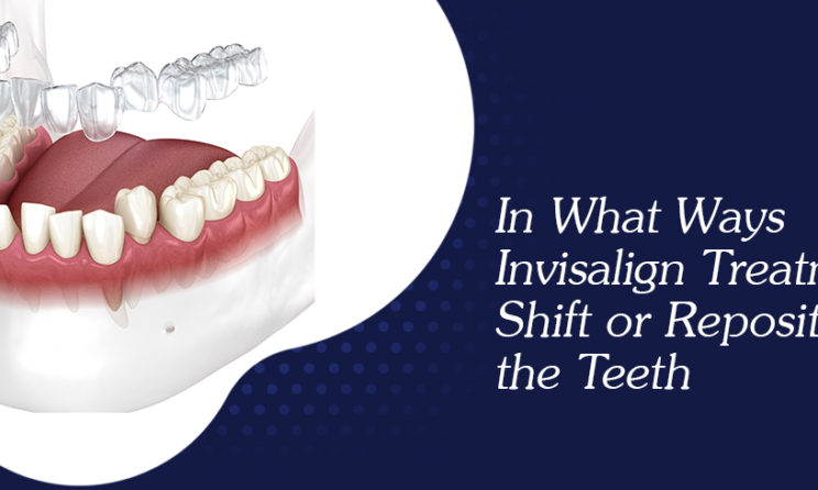 Invisalign Treatment